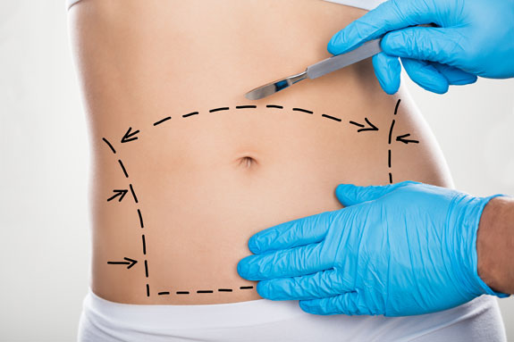 Abdominoplastik Krefeld